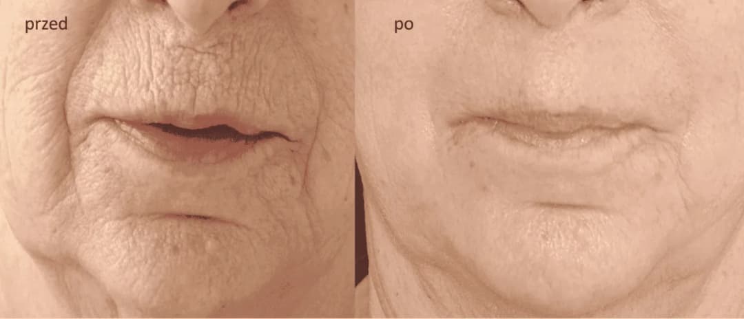 Peeling fenolowy ile się goi – poznaj czas gojenia i efekty