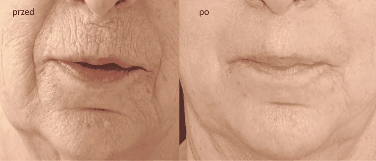 Peeling fenolowy ile się goi – poznaj czas gojenia i efekty