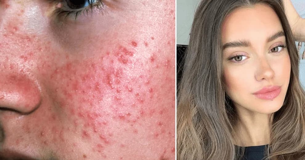 Co nałożyć po peelingu The Ordinary, aby uniknąć podrażnień skóry?