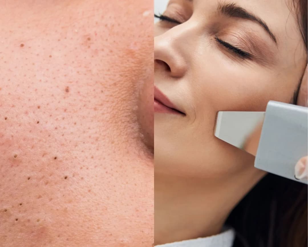 Co to jest peeling kawitacyjny i jak poprawia wygląd skóry